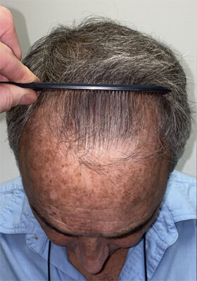 hair transplant photos