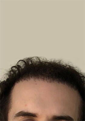 hair transplant before after Photos