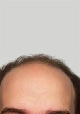 hair transplant before after Photos