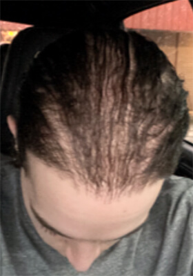 hair transplant photos