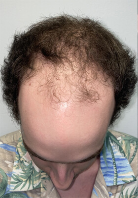 hair transplant before after Photos