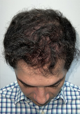 hair transplant before after Photos