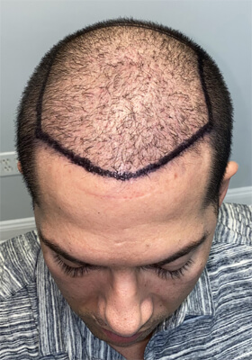 hair transplant photos