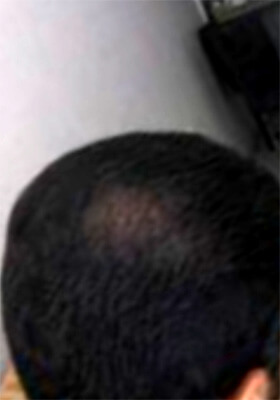 hair transplant photos