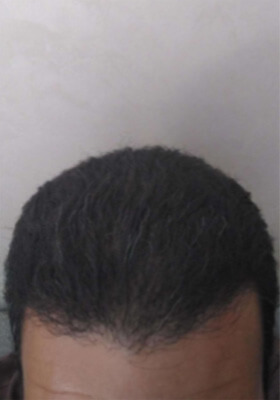 hair transplant before after Photos