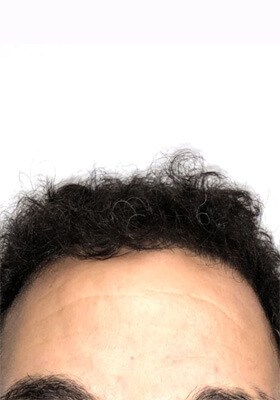 hair transplant before after Photos