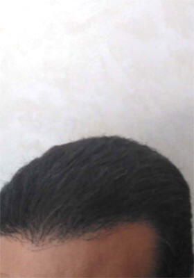 hair transplant photos