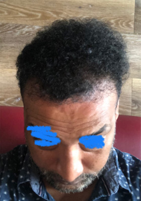 hair transplant before after Photos