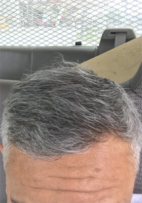 hair transplant before after Photos