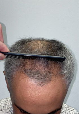 hair transplant photos