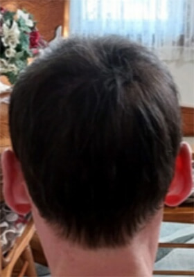 hair transplant photos