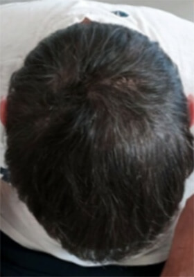 hair transplant photos