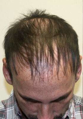 hair transplant photos