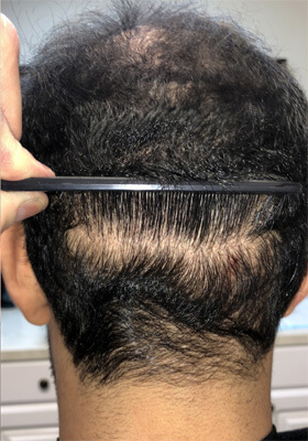 hair transplant photos