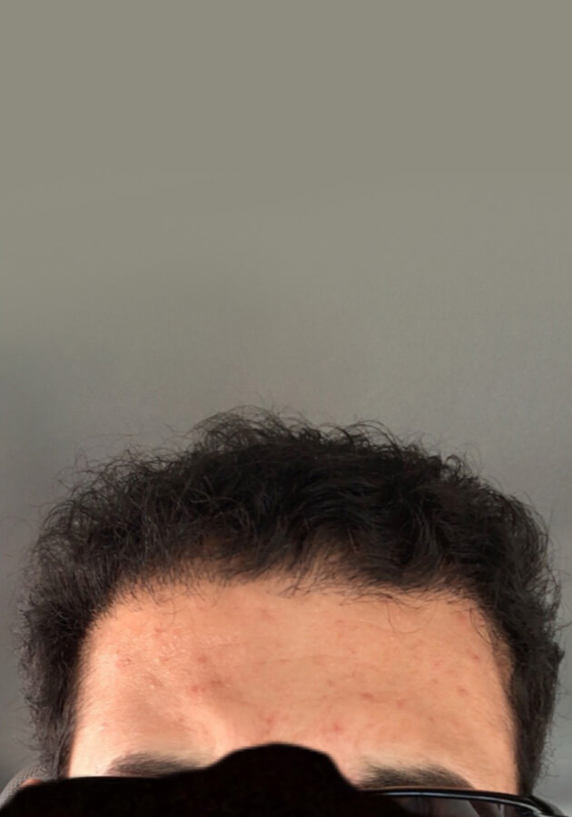 hair transplant before after Photos