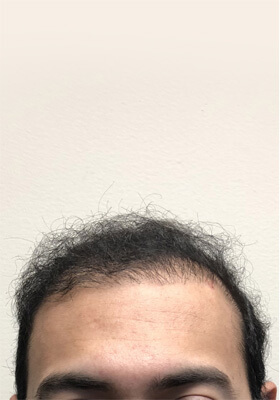 hair transplant photos