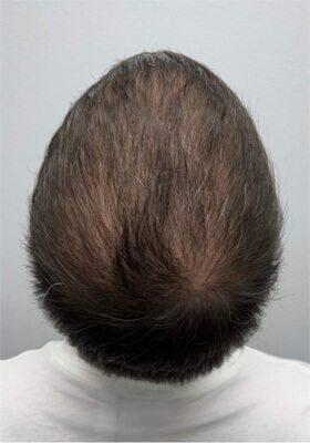 hair transplant before after Photos