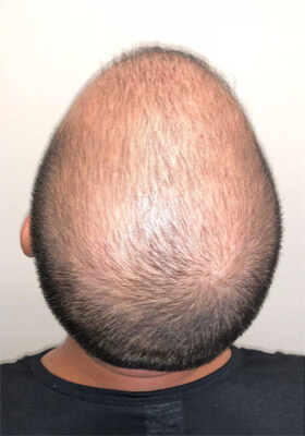 hair transplant photos