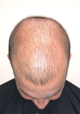 hair transplant before after Photos