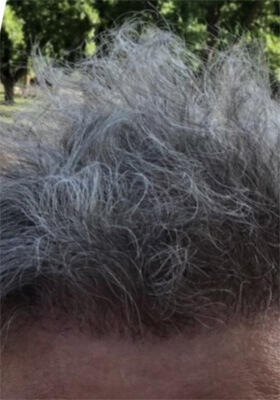 hair transplant photos