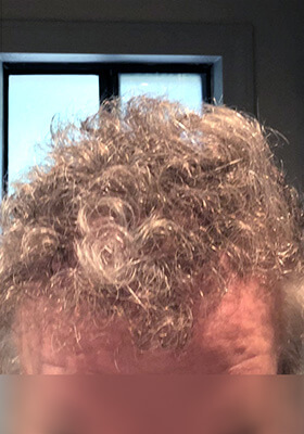 hair transplant photos