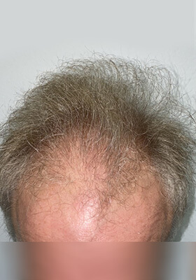 hair transplant before after Photos