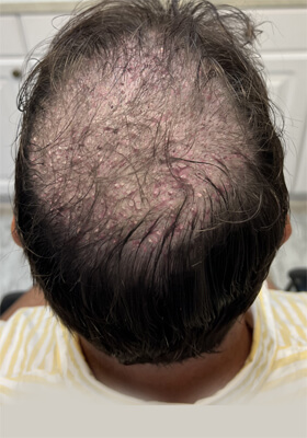 hair transplant before after Photos