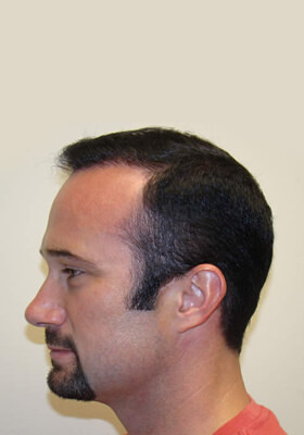 hair transplant photos