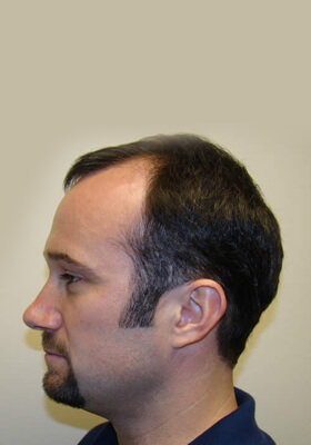 hair transplant before after Photos