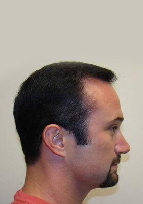 hair transplant before after Photos