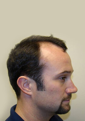 hair transplant photos