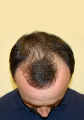 hair transplant photos