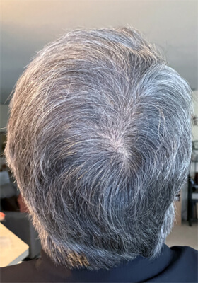 hair transplant photos