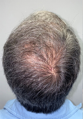 hair transplant photos