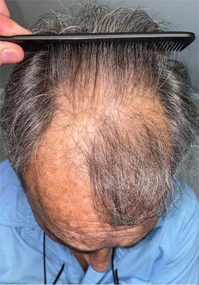 hair transplant photos