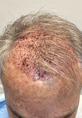 hair transplant photos