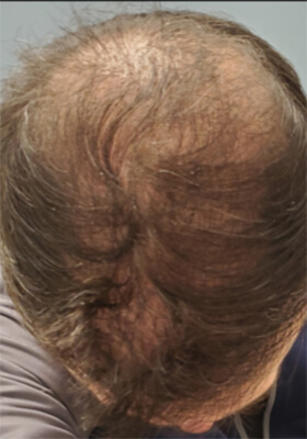 hair transplant photos