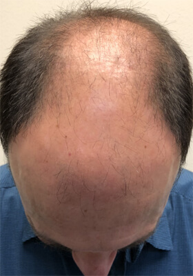 hair transplant before after Photos