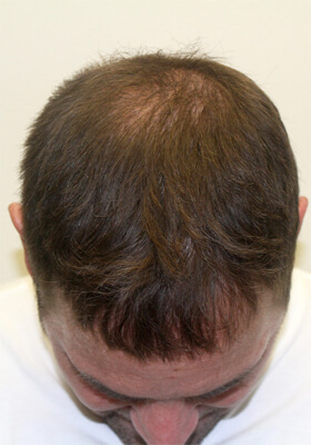 hair transplant photos