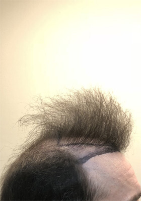 hair transplant photos