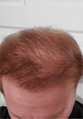 hair transplant photos