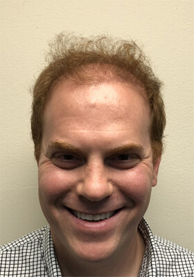 hair transplant photos