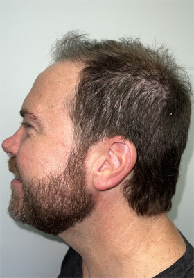 hair transplant before after Photos