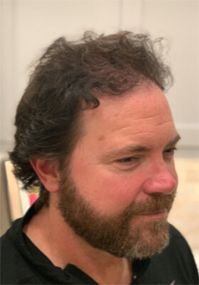 hair transplant before after Photos