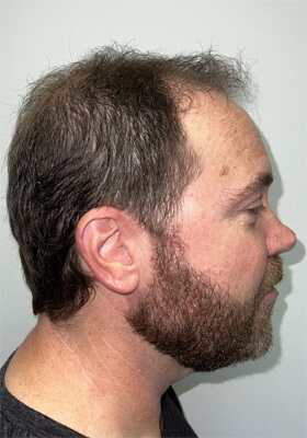 hair transplant photos