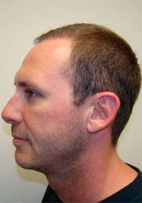 hair transplant before after Photos