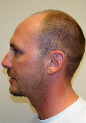 hair transplant before after Photos