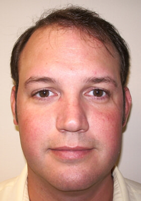 hair transplant photos