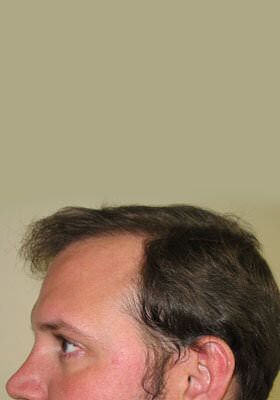 hair transplant photos