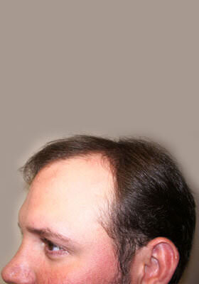 hair transplant before after Photos